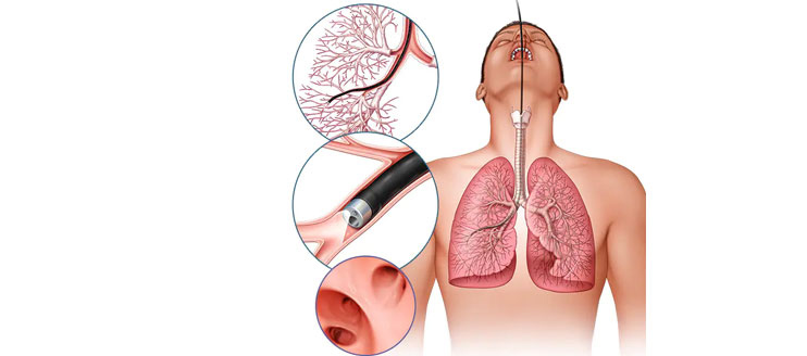 Bronchoscopic