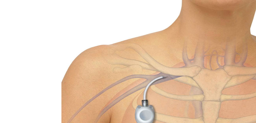 Chemoport And PICC Line Centre