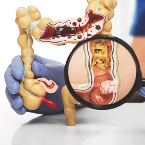 Colo-Rectal Oncosurgery