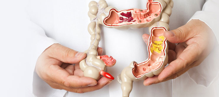 Colo-Rectal Oncosurgery