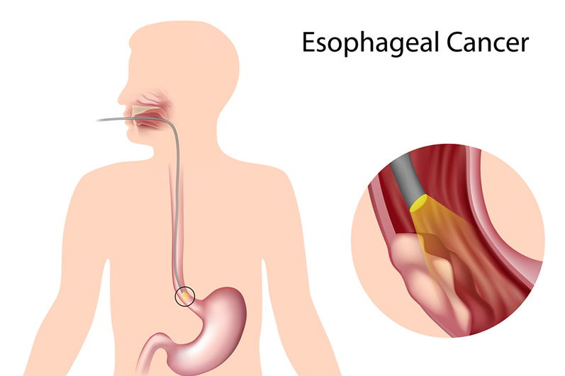 Esophageal